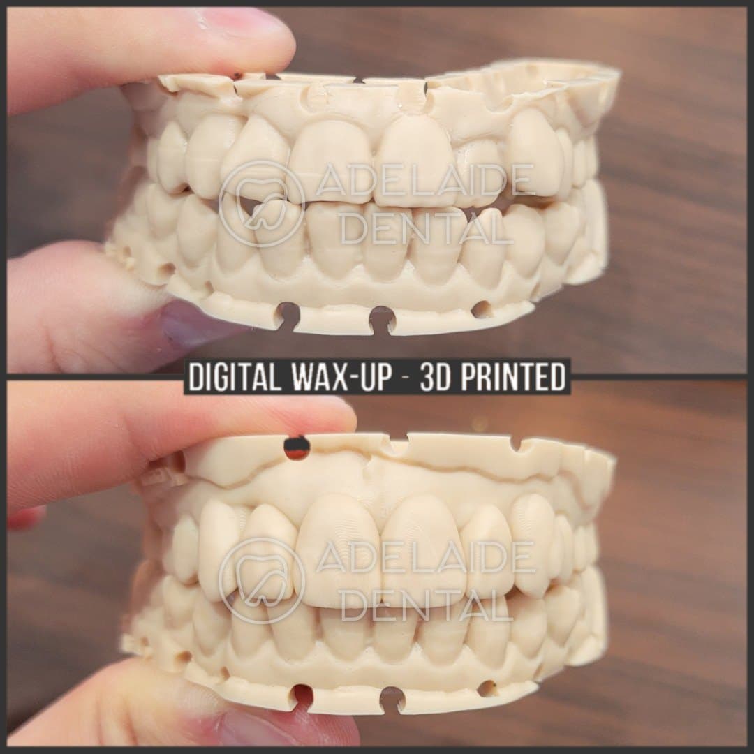 3D printed digital dental wax-up used to plan a smile makeover, by a dentist in downtown Toronto at Adelaide Dental