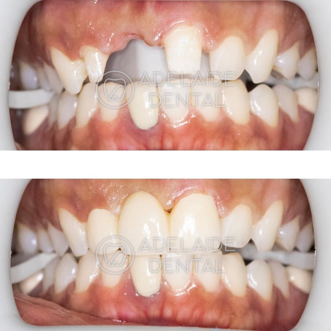 Before and after replacing a missing front tooth, by a dentist in downtown Toronto at Adelaide Dental