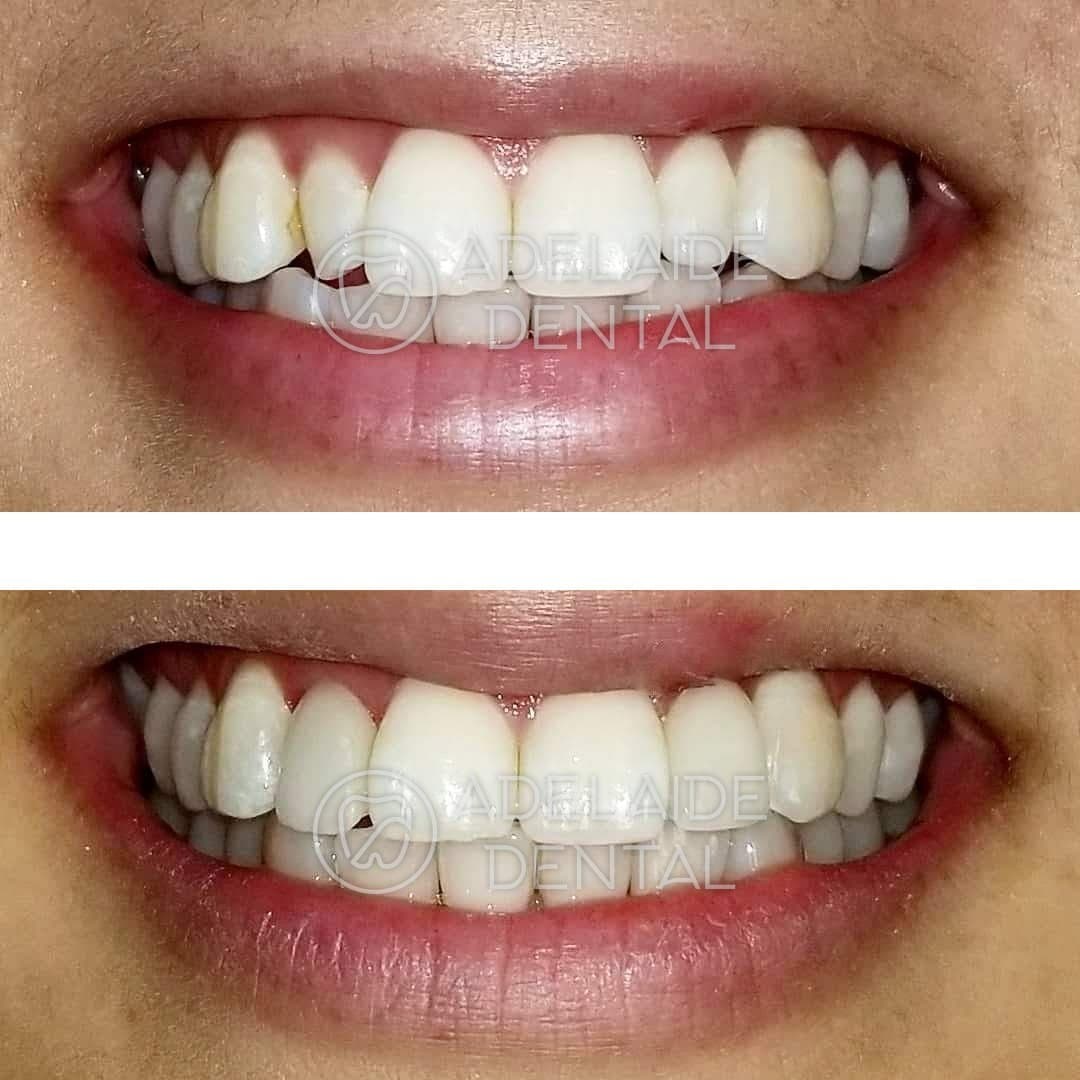 Before and after prepless porcelain veneers, by a dentist in downtown Toronto at Adelaide Dental