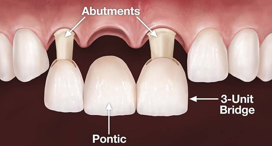 Diagram of a three-unit dental bridge: two crowns on the teeth beside the gap hold a replacement tooth between them