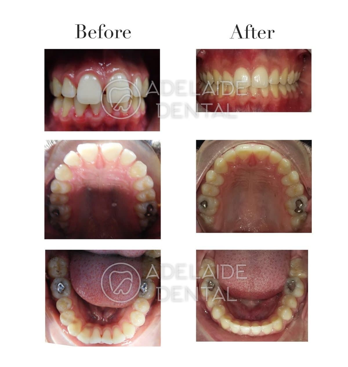 Before and after Invisalign clear aligners, closing a gap between the front teeth, by a dentist in downtown Toronto at Adelaide Dental Before and after Invisalign clear aligners, closing a gap between the front teeth, by a dentist in downtown Toronto at Adelaide Dental