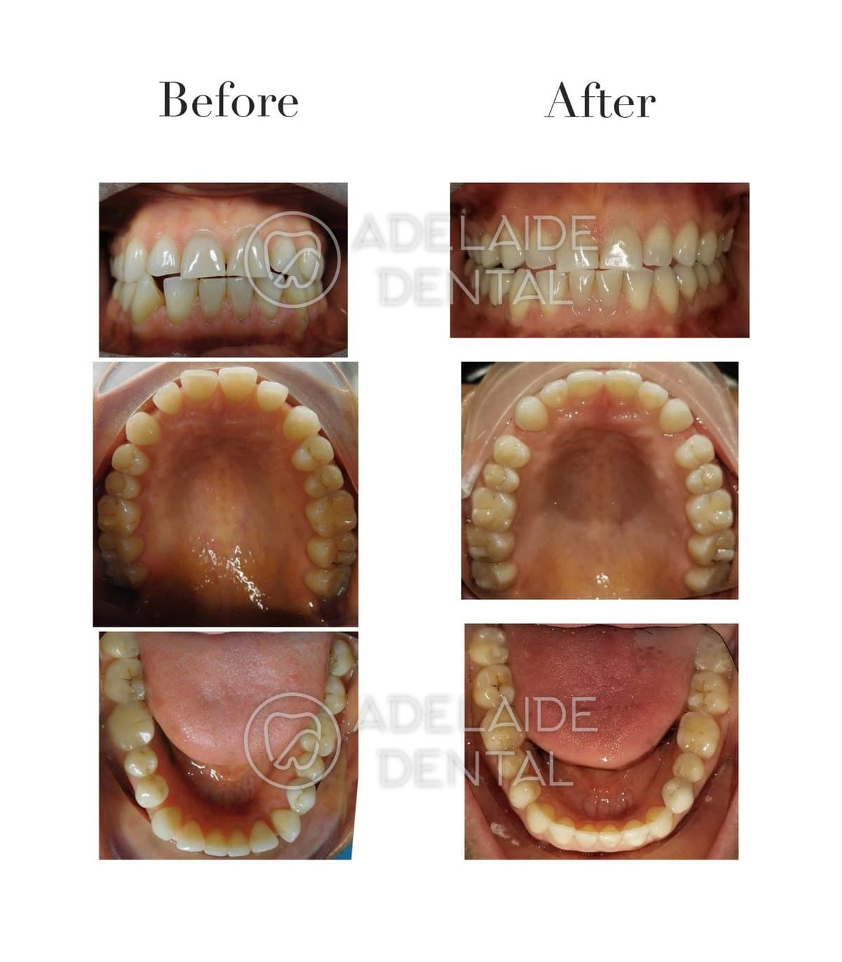 Before and after Invisalign clear aligners, straightening crowded teeth, by a dentist in downtown Toronto at Adelaide Dental Before and after Invisalign clear aligners, straightening crowded teeth, by a dentist in downtown Toronto at Adelaide Dental